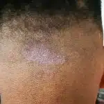 Hongos de la piel: aprenda sobre Tiña Versicolor, Onchomicosis, Candida y Dermatofitos