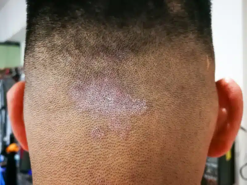 Hongos de la piel: aprenda sobre Tiña Versicolor, Onchomicosis, Candida y Dermatofitos