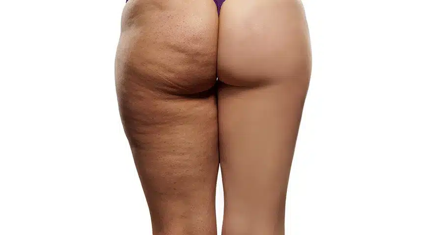 ¡Dile adiós a la celulitis! Ejercicios y tratamientos naturales que funcionan