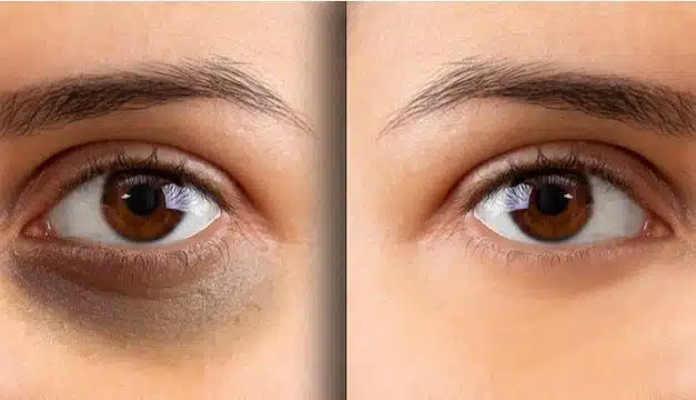 ¡No más ojeras! Cómo combatir el cansancio y lucir radiante
