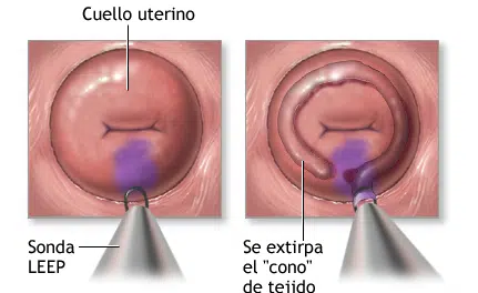 Recuperación tras una Conización: Una Experiencia Reveladora