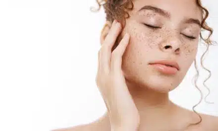 ¿La Leche Causa Acné? Analizando la Evidencia Científica y los Mitos Populares