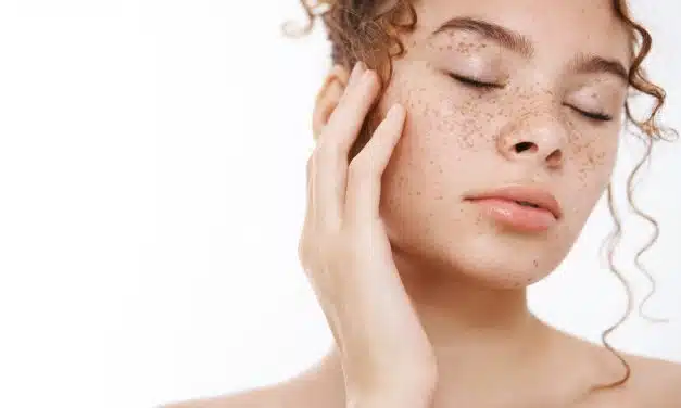 ¿La Leche Causa Acné? Analizando la Evidencia Científica y los Mitos Populares